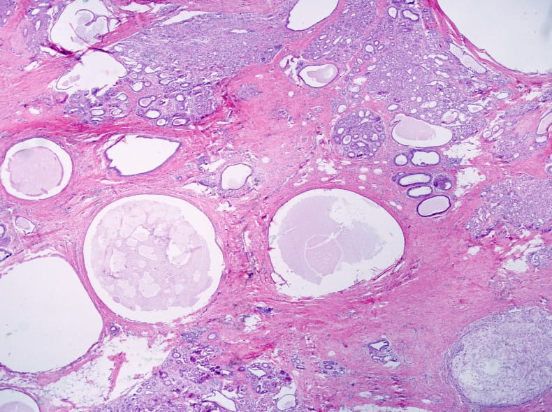 fibrocystic tissue under microscope
