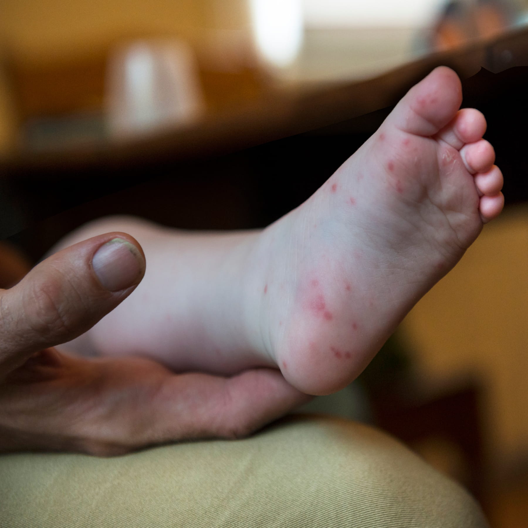 Hand, foot, and mouth disease in adults: Symptoms and treatment